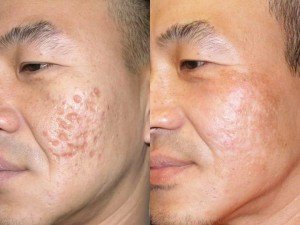 microneedling