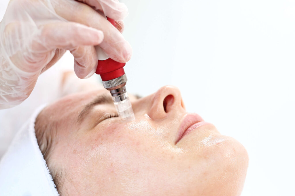 microneedling