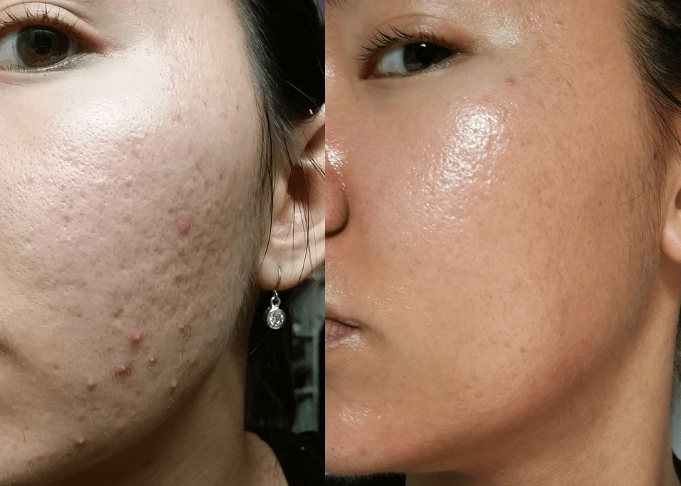 microneedling