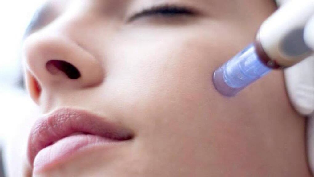 microneedling