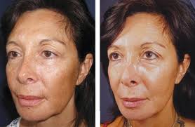 before and after of woman's face using emu oil to lessen wrinkles