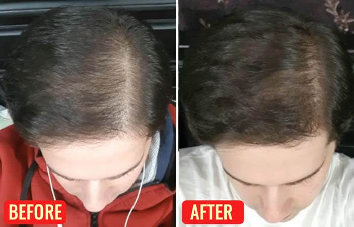 before and after of emu oil for hair growth