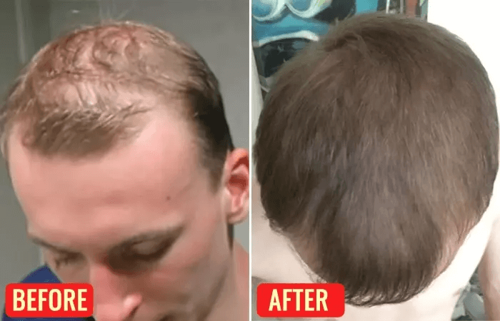 before and after of man's head using emu oil for hair growth