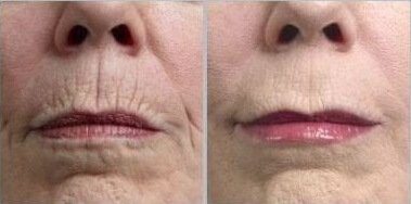 before and after of woman's face using emu oil to lessen wrinkles
