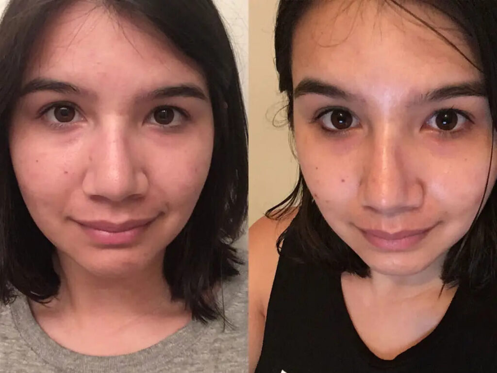 before and after of a young woman using face toner