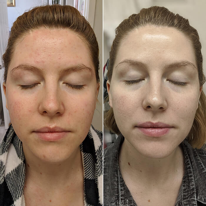 before and after results of a woman using face toner