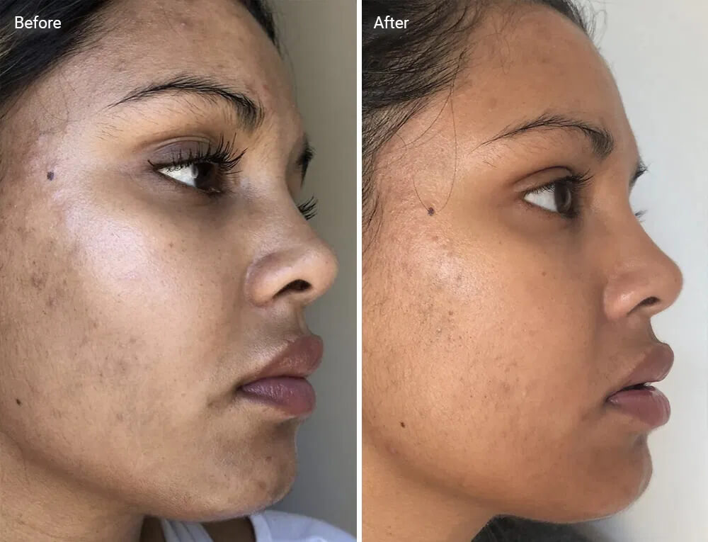 before and after result of a woman using face toner