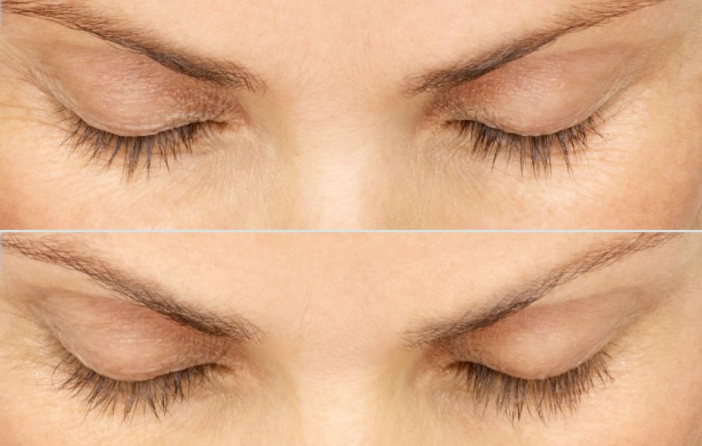 before and after of an older woman's eyelashes
