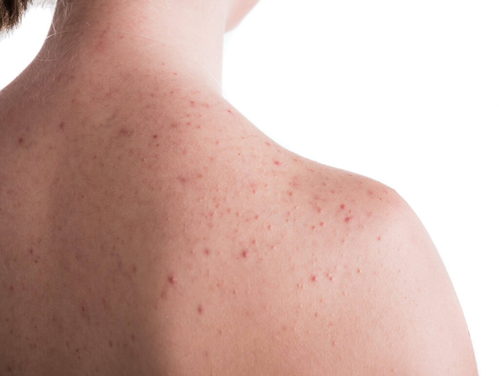 fungal acne on your back