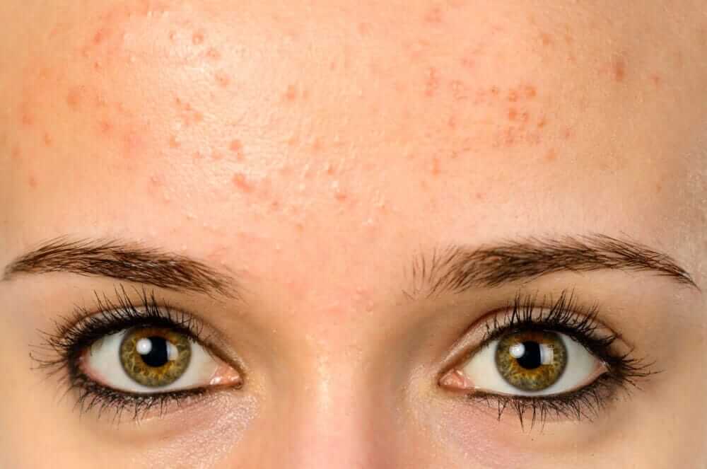 fungal acne on forehead
