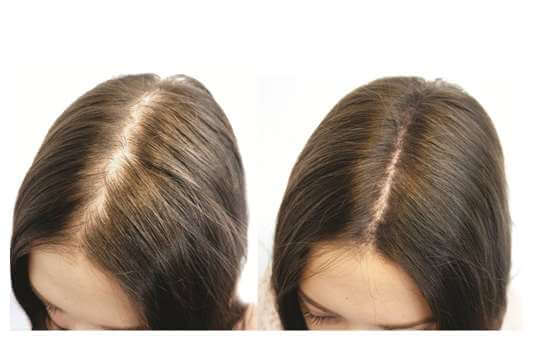 Biotin for Hair Loss Before and After