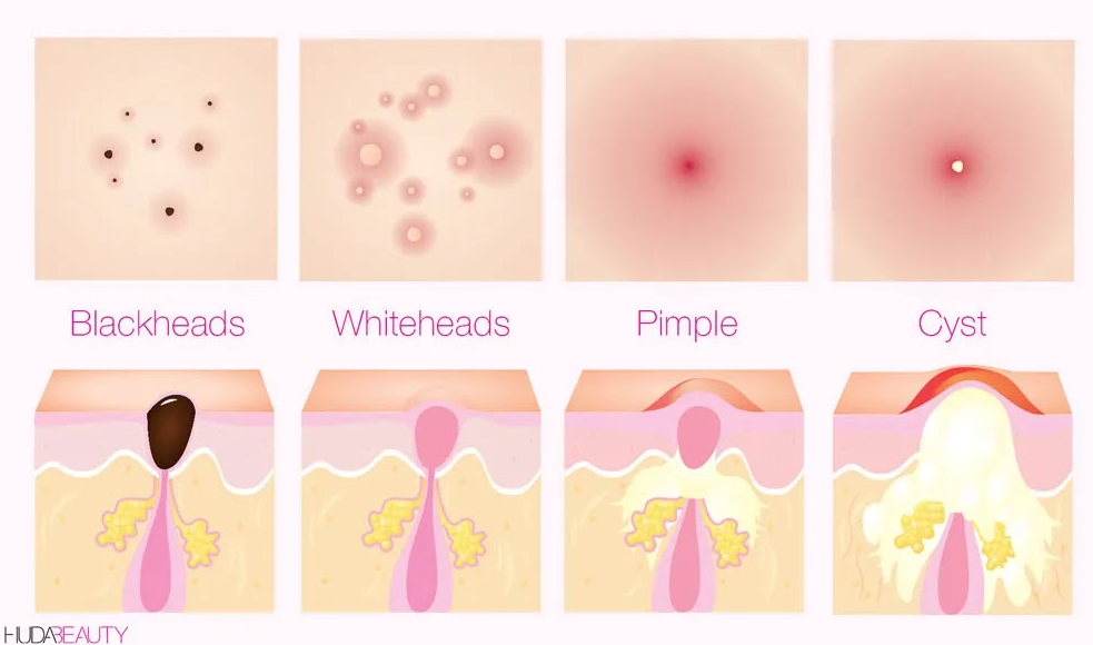 cystic acne diagram